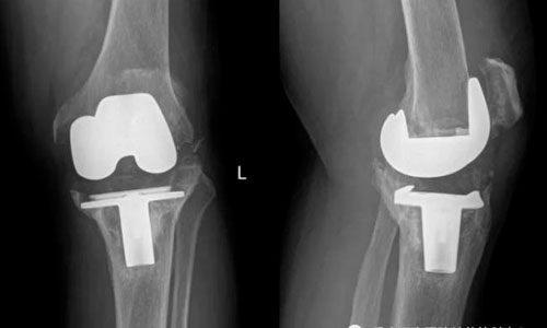 Китайцы-напечатали-на-принтере-новый-сустав-из-редкого-материала из редкого материала
