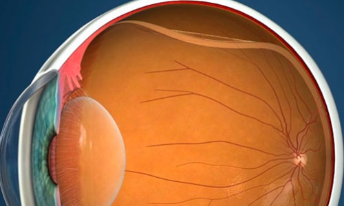 Отслоение-сетчатки Отслоение сетчатки