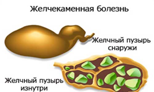 Русский-травник-при-желчекеаменной-болезни желчекеаменной болезни