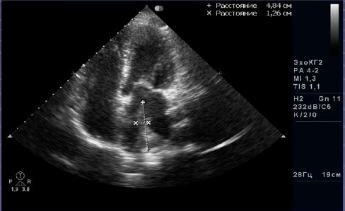Тромб-сердечный