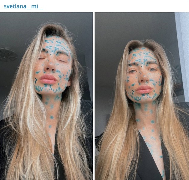 Скрывает лицо под маской: биатлонистка Миронова стала жертвой косметолога
