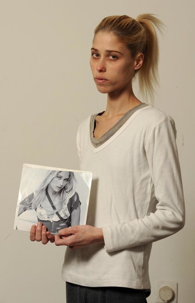 Седые волосы, кожа да кости: 35-летняя модель Карина Бауман умерла после критического похудения до 24 кг
