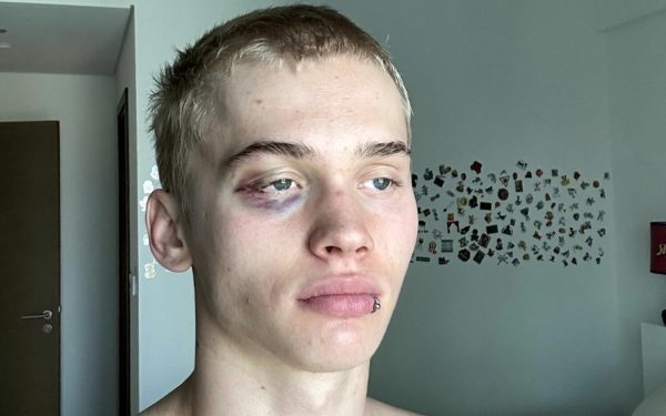 Милохину поставили синяк под глазом