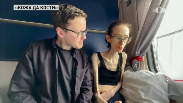 Живой скелет: в погоне за идеальным телом девушка похудела до 29 кг